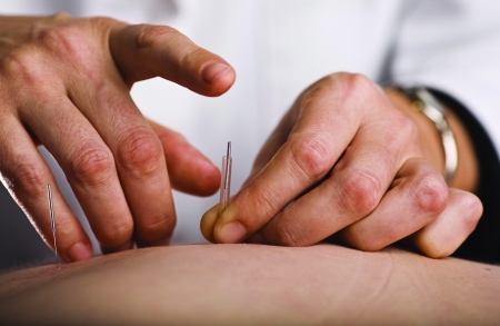 Tapping in acupuncture needle